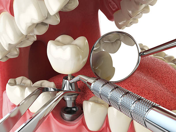 Best Knocked-Out Tooth (Avulsed Tooth) Treatment in Garwood, NJ